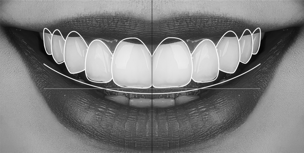 veneers West Vancouver smile makeover
